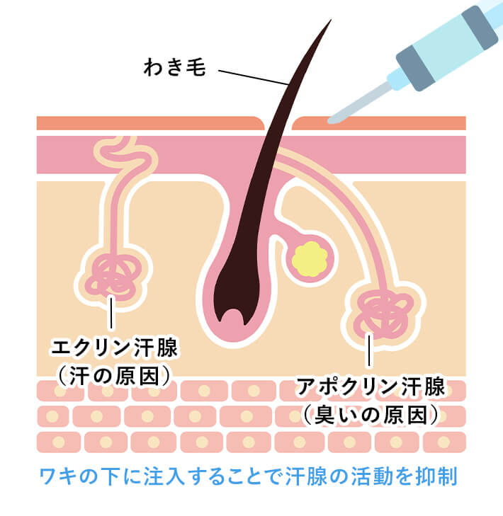 ワキの下に注入することで汗腺の活動を抑制