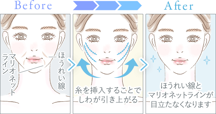 糸リフトイメージ