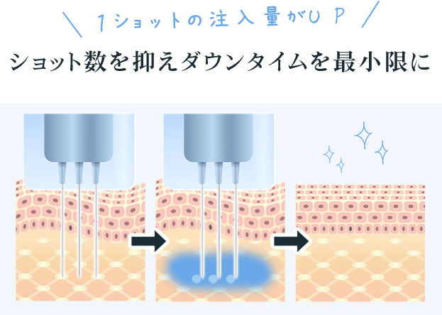 ショット数を抑えダウンタイムを最小限に