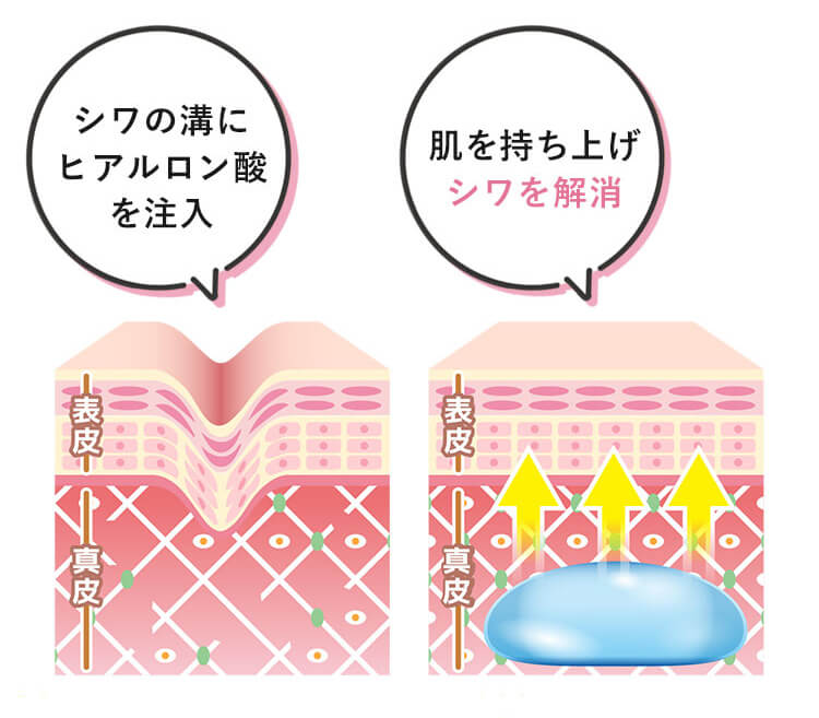 シワの溝にヒアルロン酸を注入 肌を持ち上げシワを解消